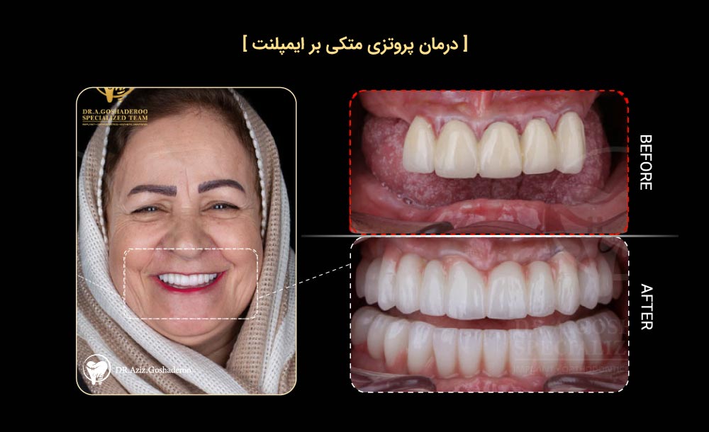 درمان پروتزی متکی بر ایمپلنت